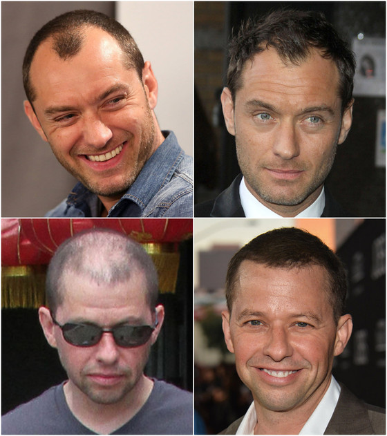 Os famosos carecas Os famosos carecas